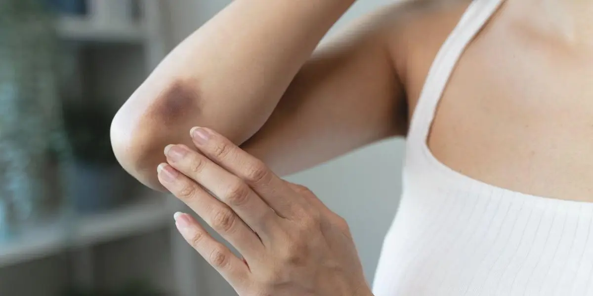 How To Get Rid Of Bruises From Blood Thinners