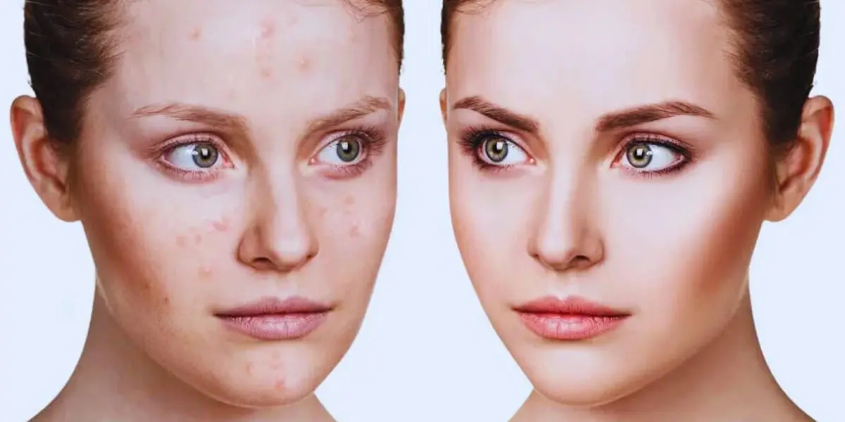 How-To-Treat-Hormonal-Acne-Without-Birth-Control
