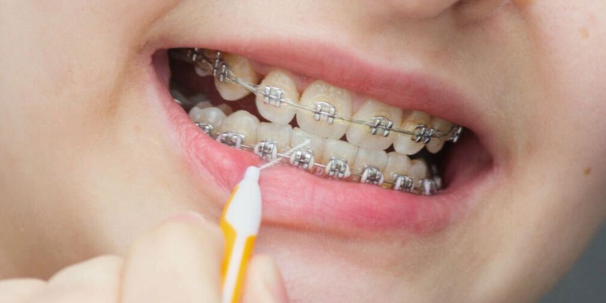 Is It Possible To Get Whiter Teeth With Braces