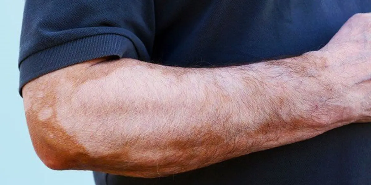 Skin Discoloration On Arms