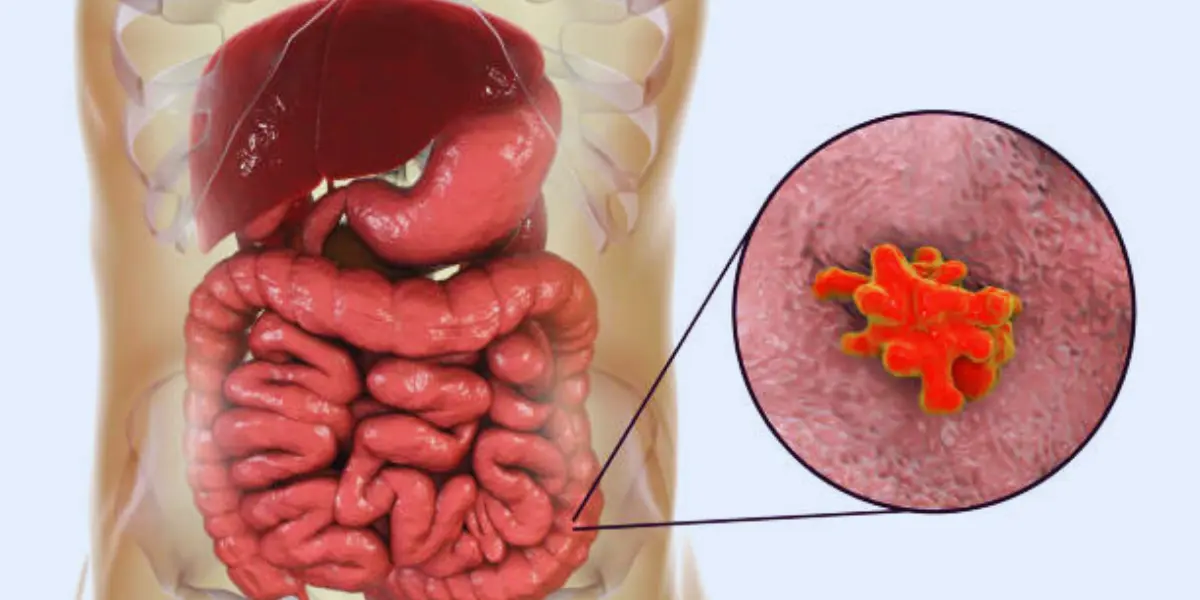 Types of Stomach Infections 