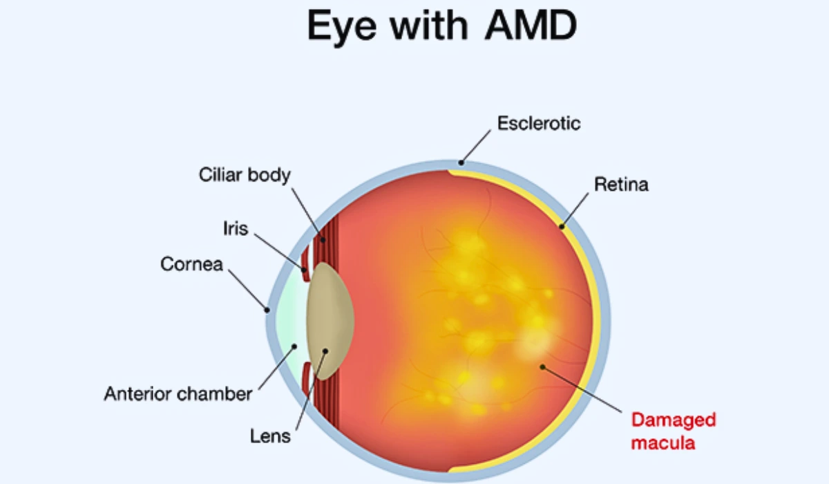 Causes of Age-related Macular Degeneration