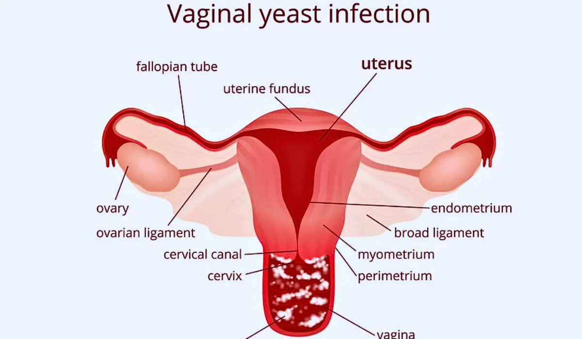 Have A Yeast Infection