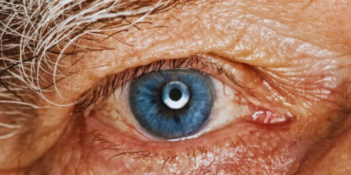Cataracts Eyr Disease