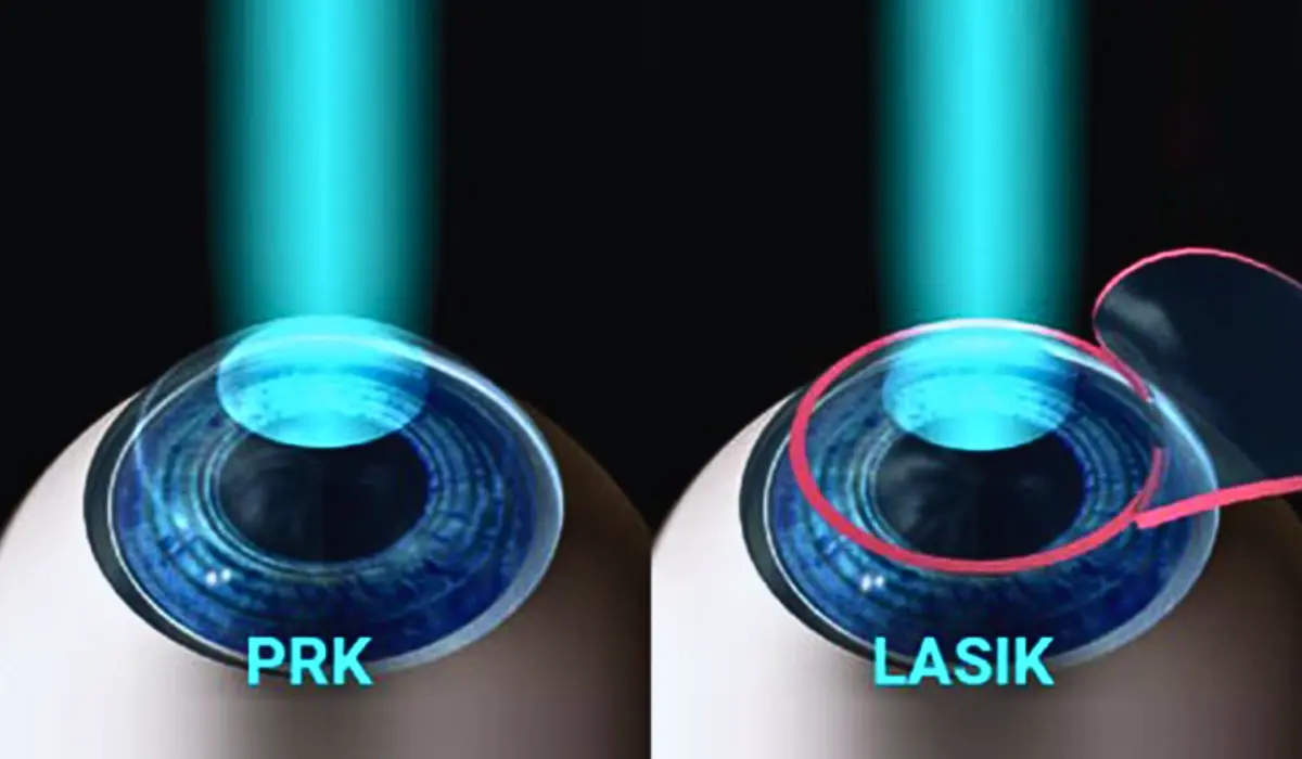 PRK and LASIK Surgery